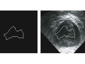 Automated Snake Initialization for the Segmentation of the Prostate in Ultrasound Images,