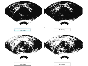 Interactive Differential Evolution for Prostate Ultrasound Image Thresholding