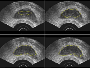 An Elliptical Level Set Method for Automatic TRUS Prostate Image Segmentation