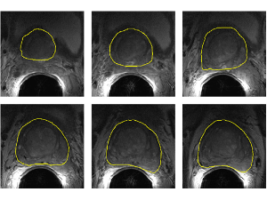 Sequential Registration-based Segmentation of Prostate Gland in MR Images